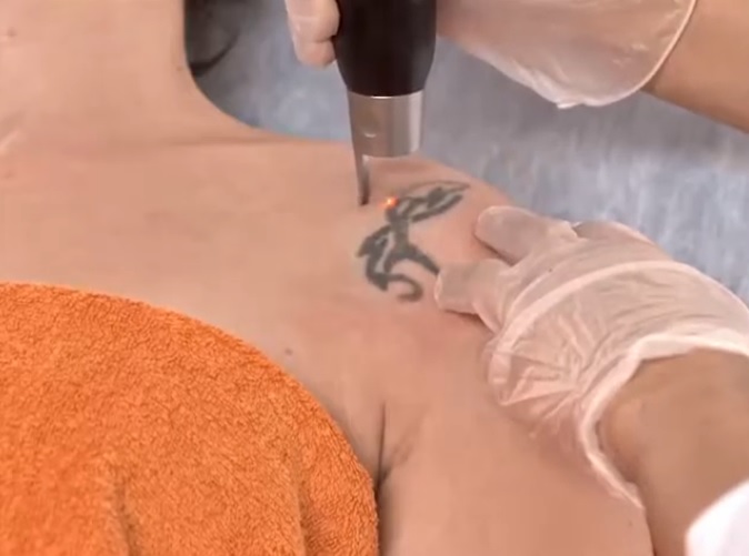Já conhecem o processo de remoção de tatuagens? Dica para quem busca solução