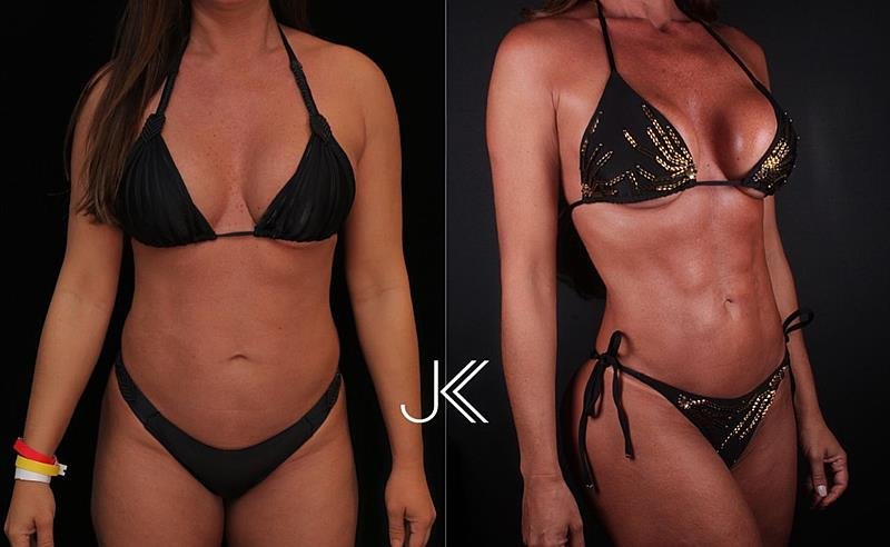 Nicole Bahls escolhe a LAD avançada JK e celebra transformação emocionante com resultado excepcional Nicole Bahls escolhe a LAD avançada JK e celebra transformação emocionante com resultado excepcional