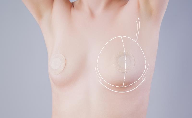 Dr. Octávio Curi Frascareli: Mastopexia em Maringá, elevação das mamas com ou sem prótese Dr. Octávio Curi Frascareli: Mastopexia em Maringá, elevação das mamas com ou sem prótese