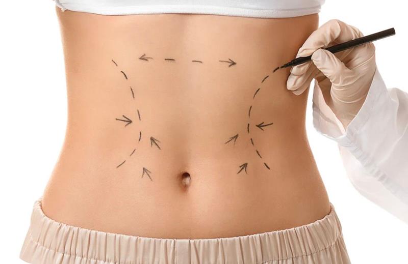 Dr. Octávio Curi Frascareli – Lipoaspiração e Lipo HD em Maringá: entenda as diferenças e como funcionam os procedimentos