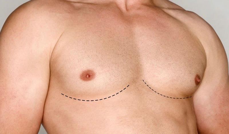 Dr. Octávio Curi Frascareli – Ginecomastia em Maringá: entenda o que é e como é feita a cirurgia