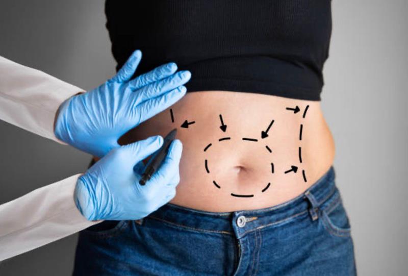 Dr. Octávio Curi Frascareli – Abdominoplastia em Maringá: quando fazer e como funciona o procedimento