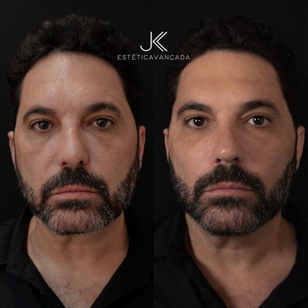 Edson, dupla de Hudson, passa por procedimento estético de rejuvenescimento na JK Estética Avançada Saiba o valor!