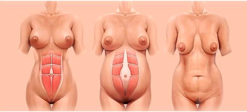 Dr. Octávio Curi Frascareli: Cirurgia da Mulher Moderna Pós-Gestação em Maringá: autoestima, firmeza e proporção