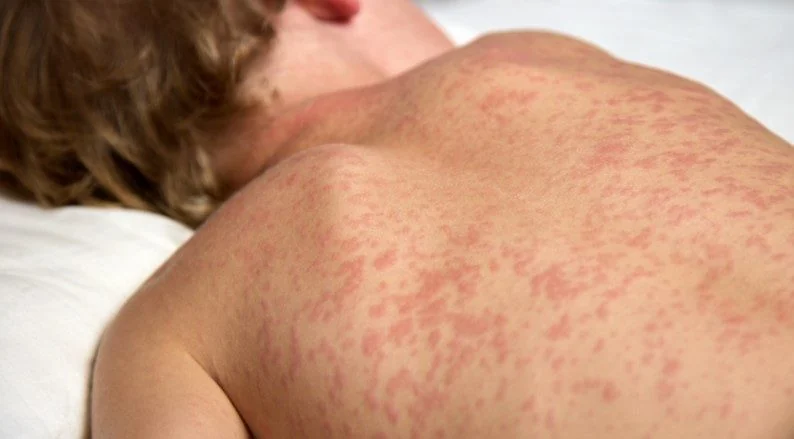 Sarampo avança com falha vacinal e reacende risco no país 1 Sarampo avança com falha vacinal e reacende risco no país